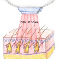 Принцип метода лазерной эпиляции